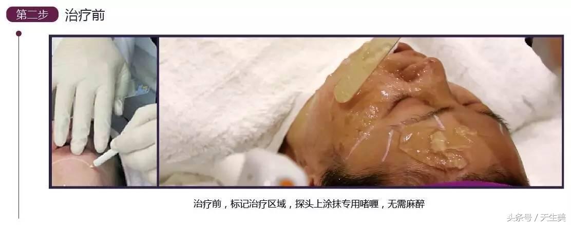 超声刀值得做吗 (超声刀怎么样啊)