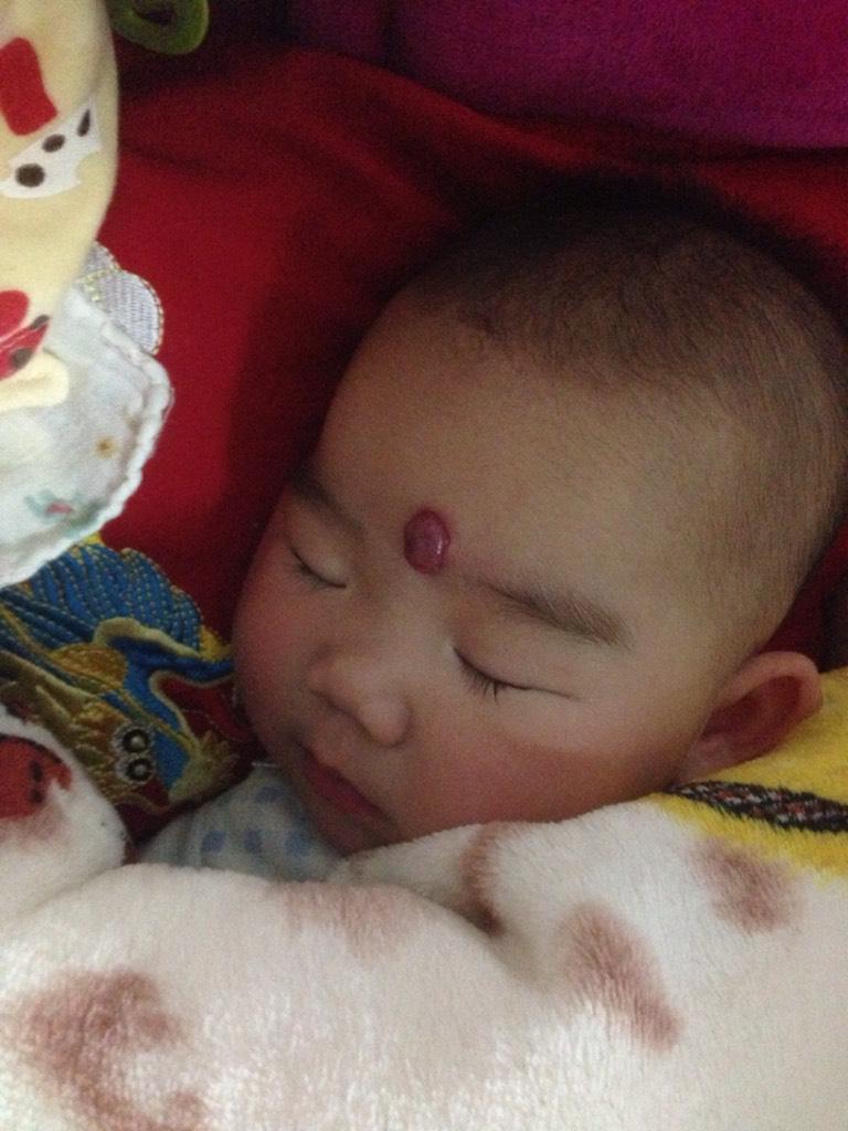 孩子有胎记是什么原因导致的,肚腰有个大胎记是祸还是福