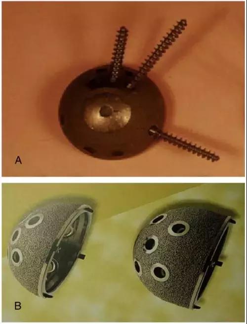 髋臼底严重骨缺损怎么翻修,髋臼骨缺损2厘米能愈合吗