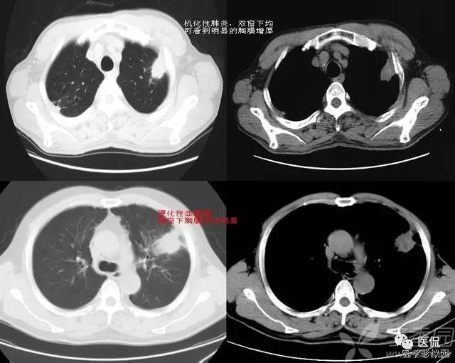 影像学呼吸系统理论知识,呼吸系统疾病影像学常见征象