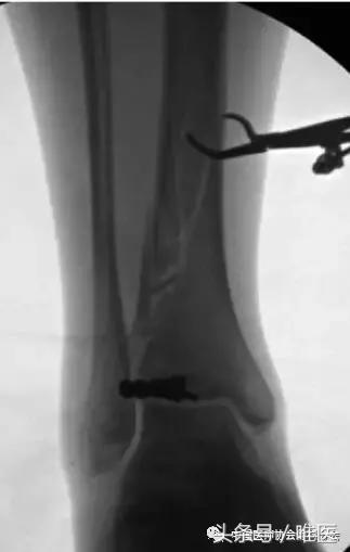胫骨骨折髓内钉固定怎么锻炼,胫骨骨折髓内钉固定牢固吗
