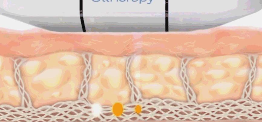 超声刀值得做吗 (超声刀怎么样啊)