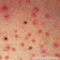 疮疖和毛囊炎的区别,毛囊炎和湿疹的区别