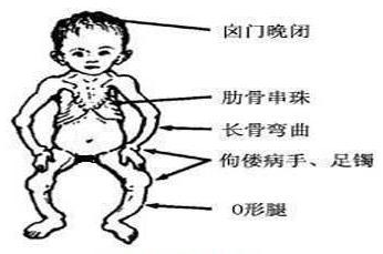 4岁男宝宝维生素d缺乏佝偻病,维生素d缺乏性佝偻病儿科护理学