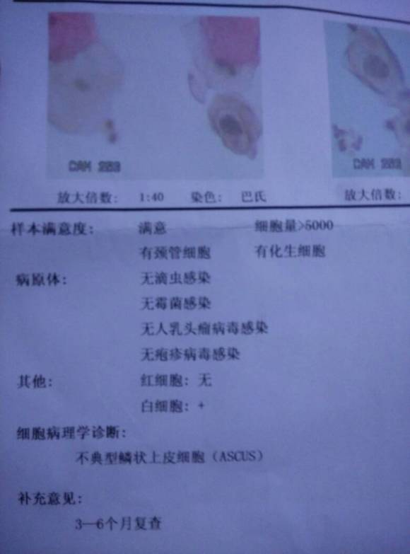 宫颈癌筛查tct报告单怎么看,宫颈癌筛查报告单tct包括什么