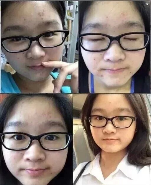 教你如何祛痘,有什么方法祛痘有效最快