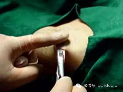 中医骨科小针刀治疗足跟痛,足跟痛看骨科好还是疼痛科好