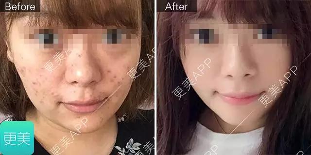 长痘痘好焦虑啊,长痘痘要用什么药治疗