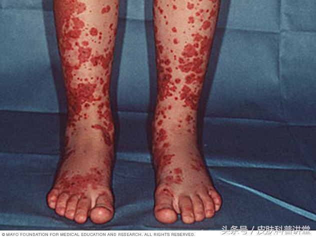 过敏性紫癜小腿胳膊有红点,过敏性紫癜一走路小腿就起红点