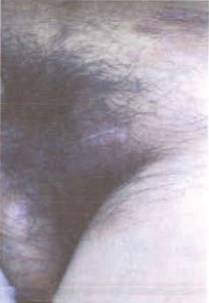 红色斑丘疹是湿疹吗,红斑丘疹误诊湿疹