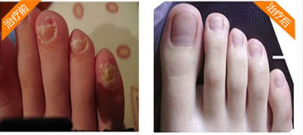 这一个小处方能搞定你长久不愈的灰指甲