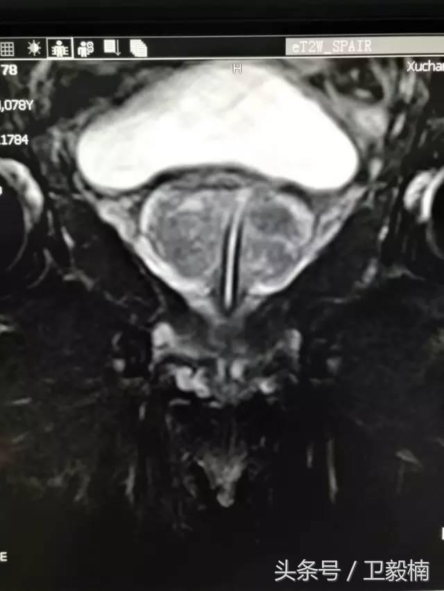 微创介入科一卫毅楠,什么是心血管介入治疗