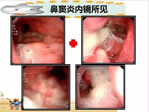 咳嗽咳痰反复发烧,宝宝反复咳嗽咳痰
