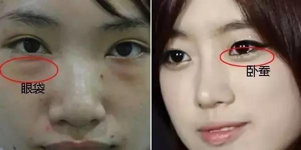 眼袋和卧蚕的区别看完你就知,卧蚕和眼袋的区别你知道吗