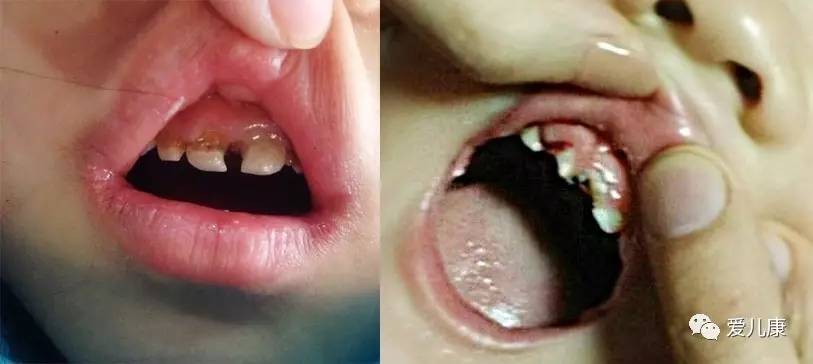 奶瓶龋和牙釉质发育不全,奶瓶龋齿对容貌的影响