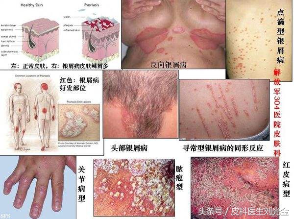 银屑病患者适合生二胎吗,孕妇长银屑藓要怎么处理