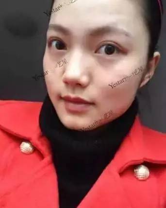 激光祛斑后还会反弹吗,激光祛斑后会不会反弹