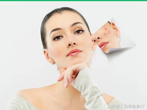 痘痘易祛,痘印长存!这样做才能拯救受损的痘印肌肤