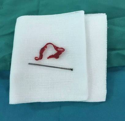 医生在儿童耳朵里取出异物,医生给小孩耳朵取异物视频