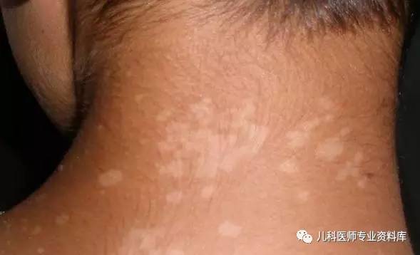 湿疹后有白斑是怎么回事,湿疹后白斑是白癜风
