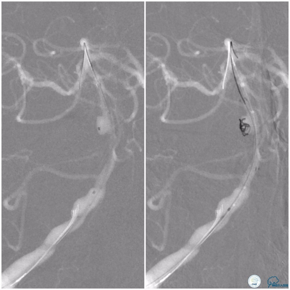 天坛周记|基底动脉狭窄合并动脉瘤血管内介入治疗一例
