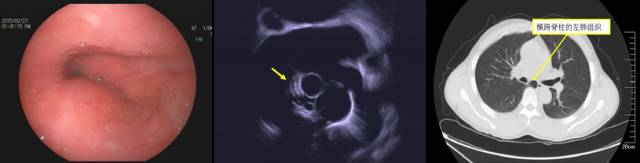 当EUS遇到“假瘤子”(二)——都是“隔壁老王”惹的祸(毗邻外压)