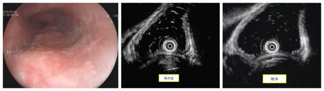 当EUS遇到“假瘤子”(二)——都是“隔壁老王”惹的祸(毗邻外压)