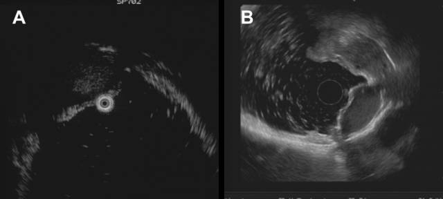 当EUS遇到“假瘤子”(二)——都是“隔壁老王”惹的祸(毗邻外压)