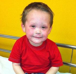 小孩出湿疹最好的解决办法,孩子湿疹更需要被重视