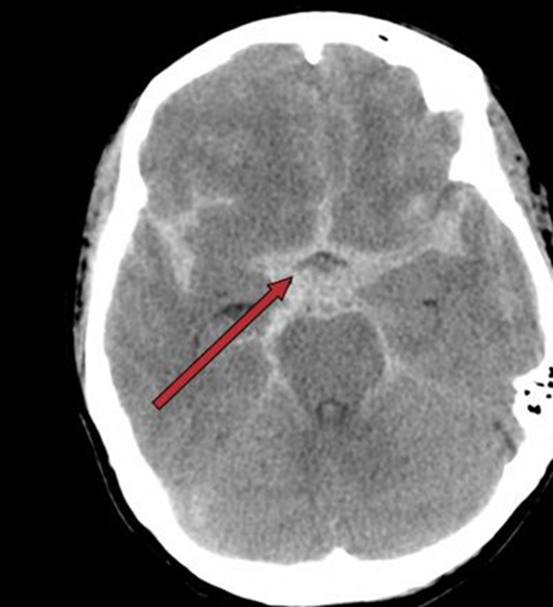 老年人头痛想吐什么原因,老人呕吐是中风前征兆吗