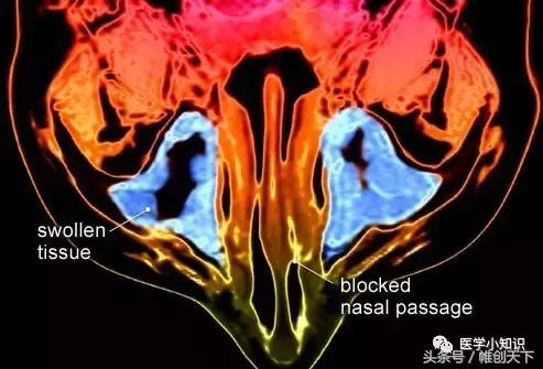 鼻窦炎图片和治疗方法,副鼻窦炎最好的治疗方法