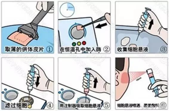 白癜风面积比较大怎么办