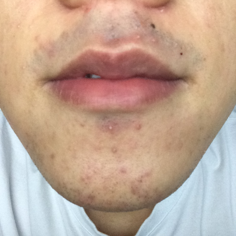 痘痘都是去哪里治好的,三角区长痘痘治疗的全部过程