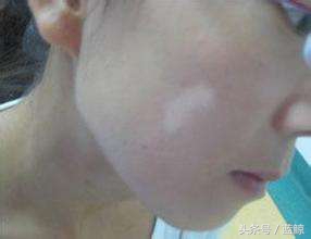 女性得白癜风能怀孕吗,女性大腿根部白癜风