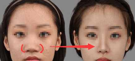 有多少人隆鼻后悔了,隆鼻的十大猫腻