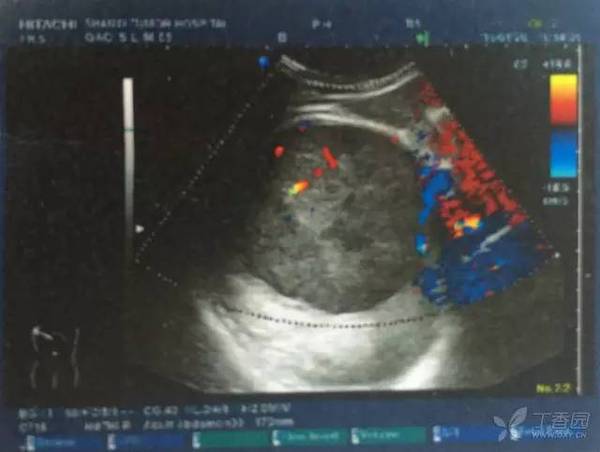 贲门癌转移肝癌4期是什么程度,得了贲门癌和肝癌能活多久