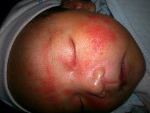 治湿疹糖皮质激素,治湿疹要调理脾胃吗