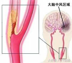 颈动脉堵塞会引起呼吸困难吗,颈动脉血管堵塞60%严重吗