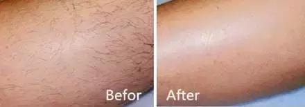 不要轻易的尝试脱毛,脱毛时大家都在做什么