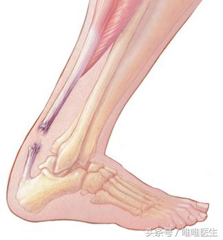 韧带损伤需要注意的事项,韧带损伤患者保守治疗的康复之路