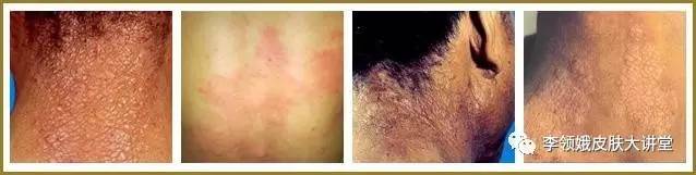 神经性皮炎牛皮癣湿疹会传染吗,头皮神经性皮炎和牛皮癣的区别