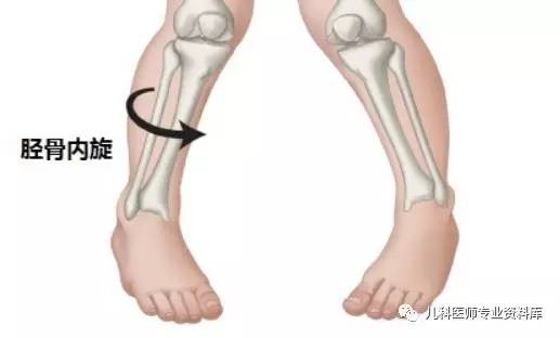 儿童内八字脚穿什么鞋,儿童内八字脚是怎么回事