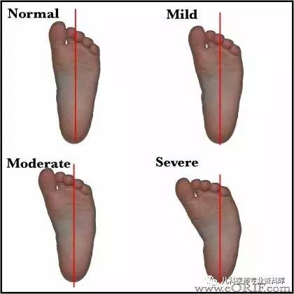 儿童内八字脚穿什么鞋,儿童内八字脚是怎么回事
