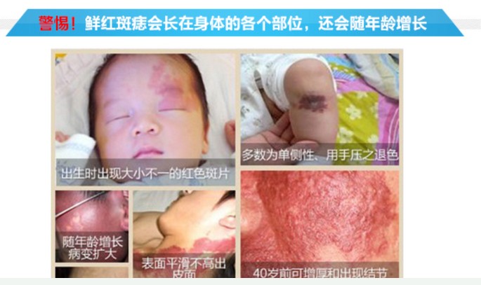 鲜红斑痣专家,鲜红斑痣一定要治疗吗