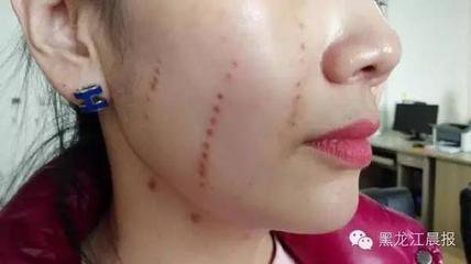 超声刀做起来有什么副作用,超声刀要不要用