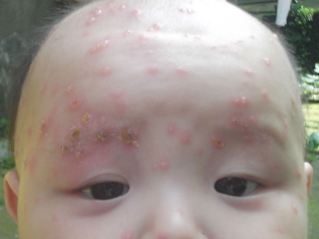 六个月宝宝感染水痘,六个月宝宝出水痘发烧了怎么办