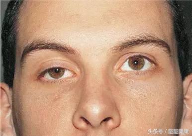 一天喝5瓶可乐的大爷,男子1天8瓶可乐患糖尿病