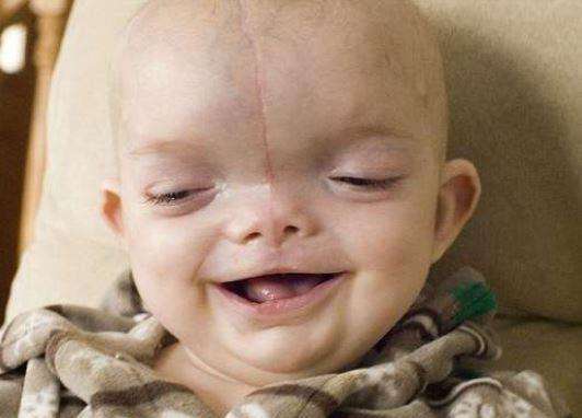 一个小孩一出生就长着猪鼻子,刚出生的婴儿猪鼻子