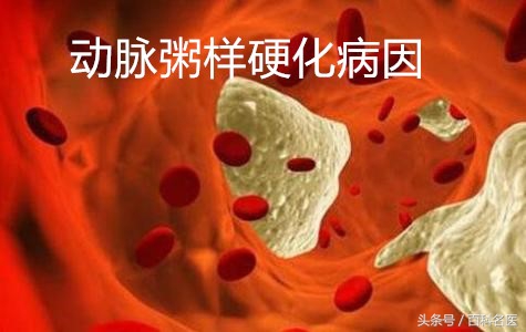 哪些人是动脉粥样硬化的高危人群,动脉粥样硬化该怎样预防和治疗