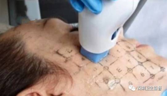 超声刀抗衰老效果,超声波抗衰美容效果怎么样